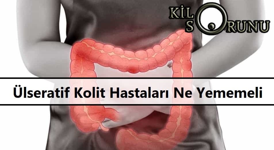 Ülseratif Kolit Hastaları Ne Yememeli